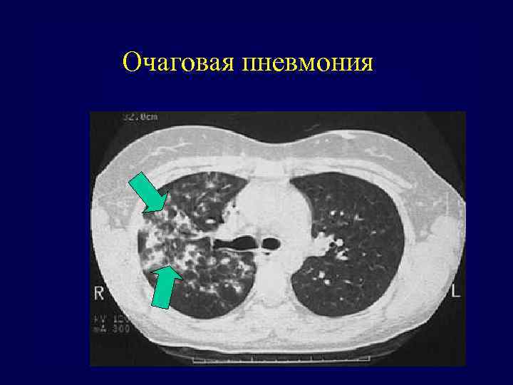 Очаговая пневмония 