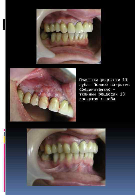 Пластика рецессии 13 зуба. Полное закрытие соединительно – тканным рецессии 13 лоскутом с неба