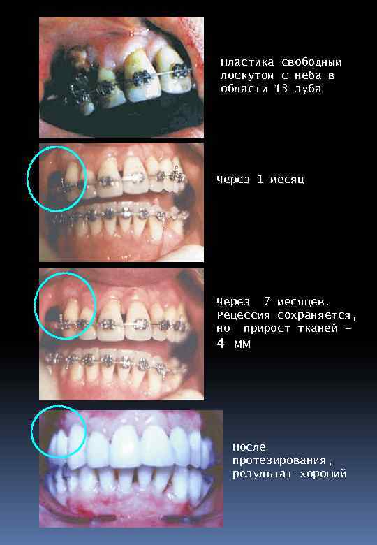 Пластика свободным лоскутом с нёба в области 13 зуба Через 1 месяц Через 7