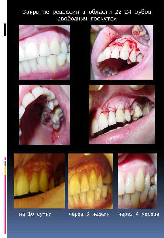 Закрытие рецессии в области 22 -24 зубов свободным лоскутом на 10 сутки через 3