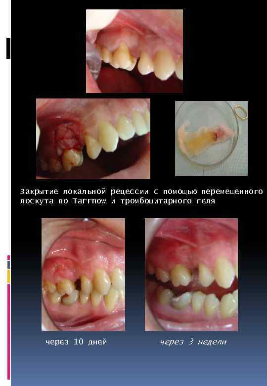 Закрытие локальной рецессии с помощью перемещенного лоскута по Tarrnow и тромбоцитарного геля через 10