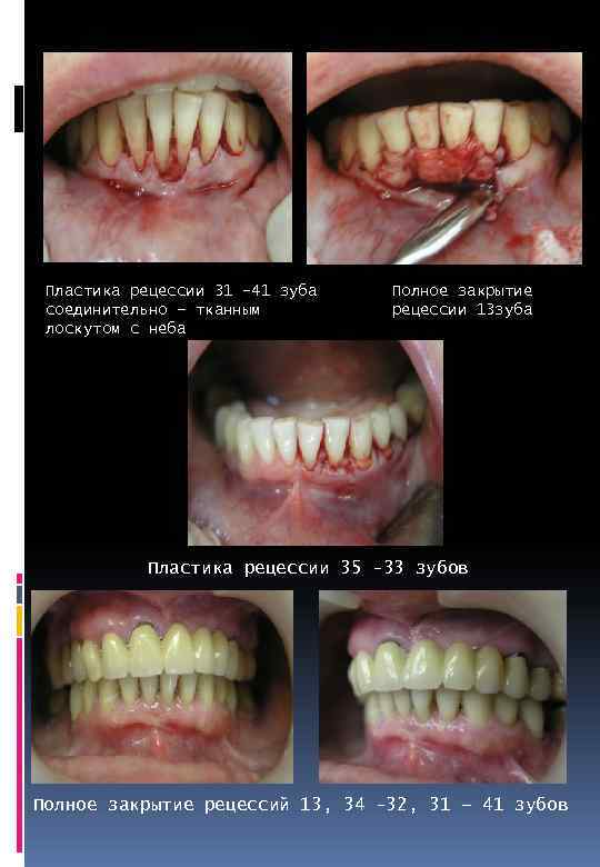 Пластика рецессии 31 -41 зуба соединительно – тканным лоскутом с неба Полное закрытие рецессии