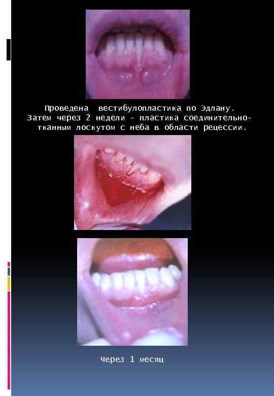 Проведена вестибулопластика по Эдлану. Затем через 2 недели - пластика соединительнотканным лоскутом с неба