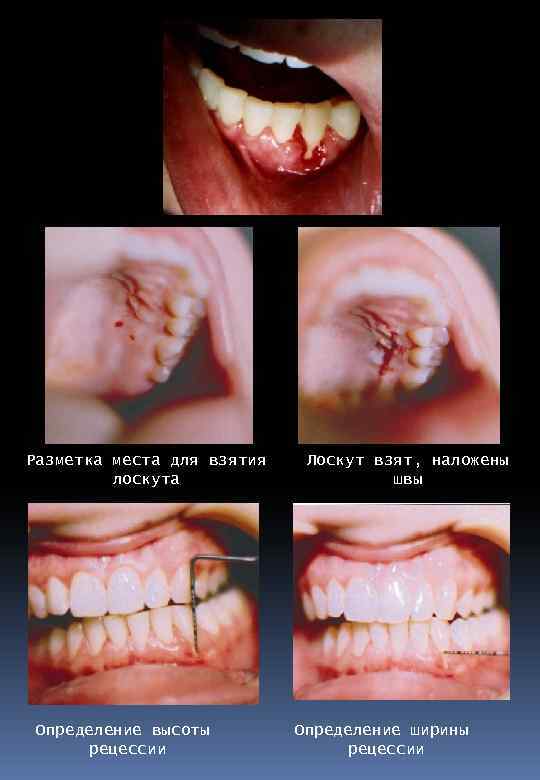 Разметка места для взятия лоскута Определение высоты рецессии Лоскут взят, наложены швы Определение ширины