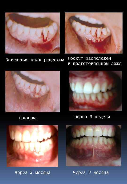 Освежение края рецессии Лоскут расположен в подготовленном ложе Повязка Через 2 месяца Через 3