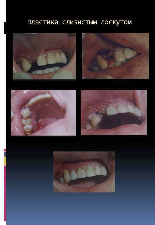 Пластика слизистым лоскутом 