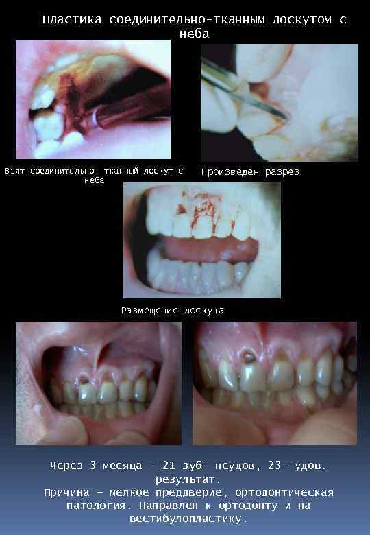 Пластика соединительно-тканным лоскутом с неба Взят cоединительно- тканный лоскут с неба Произведен разрез Размещение
