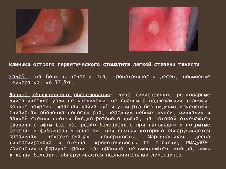 Клиника острого герпетического стоматита легкой степени тяжести Жалобы: на боли в полости рта, кровоточивость