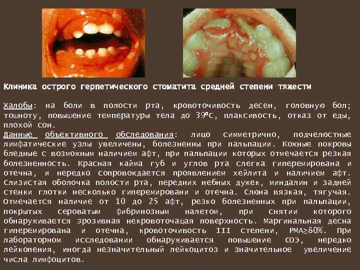 Клиника острого герпетического стоматита средней степени тяжести Жалобы: на боли в полости рта, кровоточивость