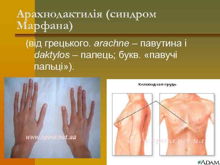 Арахнодактилія (синдром Марфана) (від грецького. arachne – павутина і daktylos – палець; букв. «павучі