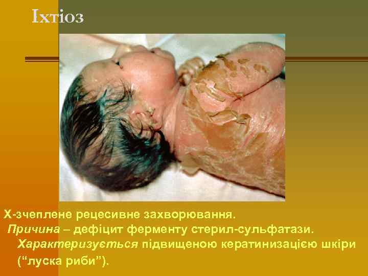 Іхтіоз Х-зчеплене рецесивне захворювання. Причина – дефіцит ферменту стерил-сульфатази. Характеризується підвищеною кератинизацією шкіри (“луска