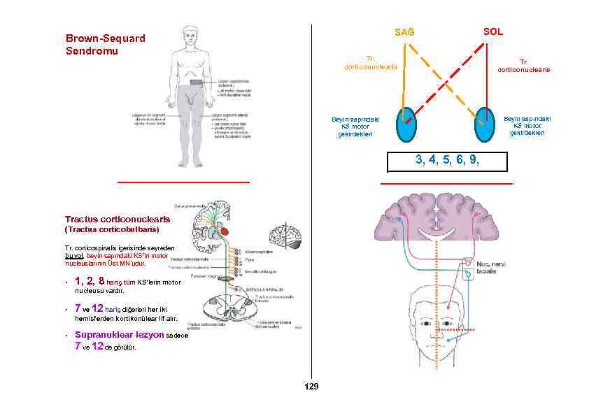 SOL SAĞ Brown-Sequard Sendromu Tr. corticonuclearis Beyin sapındaki KS motor çekirdekleri 3, 4, 5,