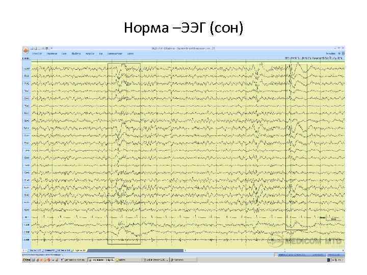 Норма –ЭЭГ (сон) 