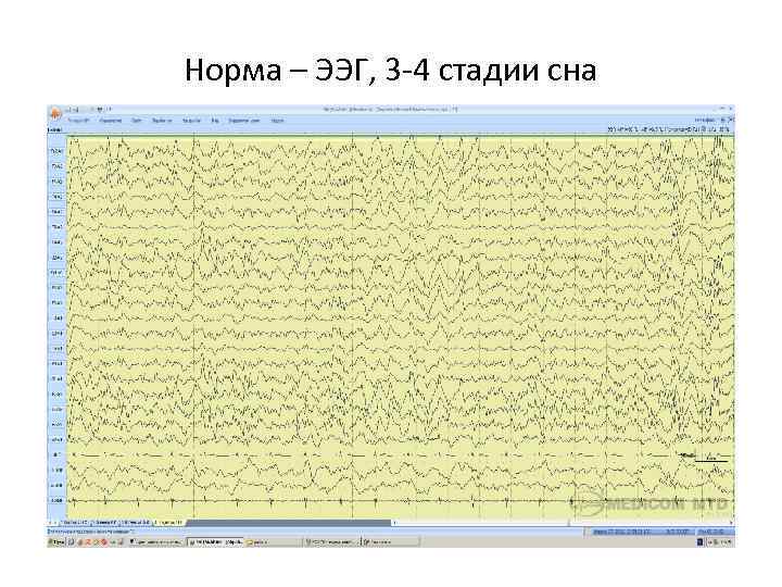 Норма – ЭЭГ, 3 -4 стадии сна 