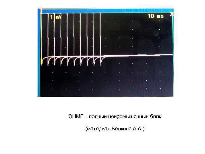 ЭНМГ – полный нейромышечный блок (материал Белкина А. А. ) После 
