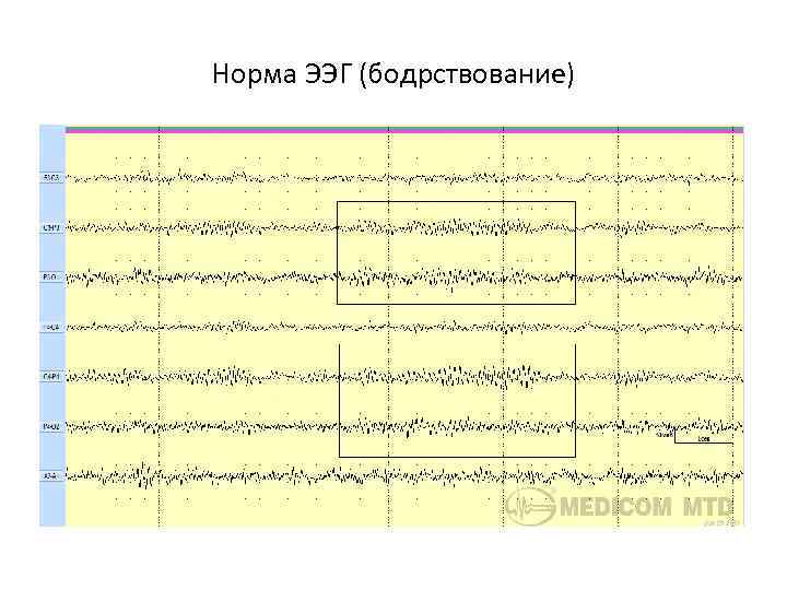 Норма ЭЭГ (бодрствование) 