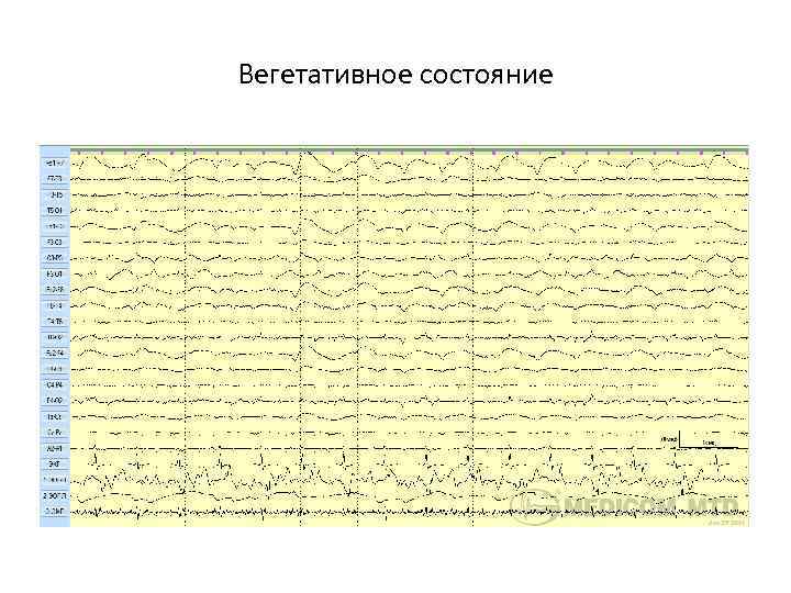 Вегетативное состояние 