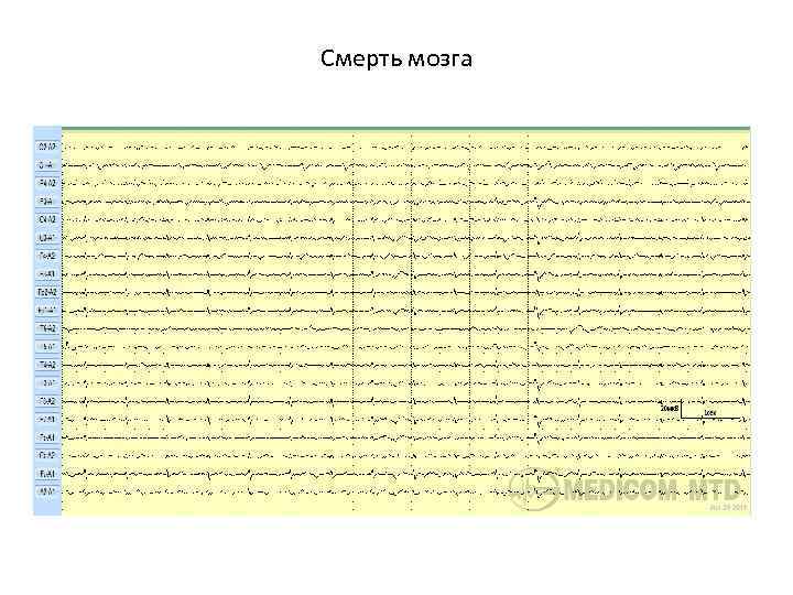 Смерть мозга 