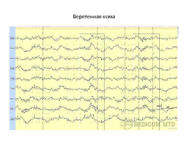 Веретенная кома 