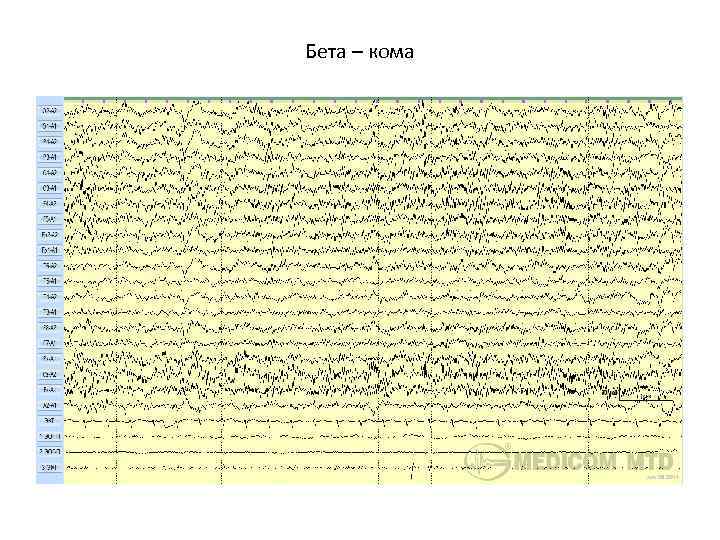 Бета – кома 