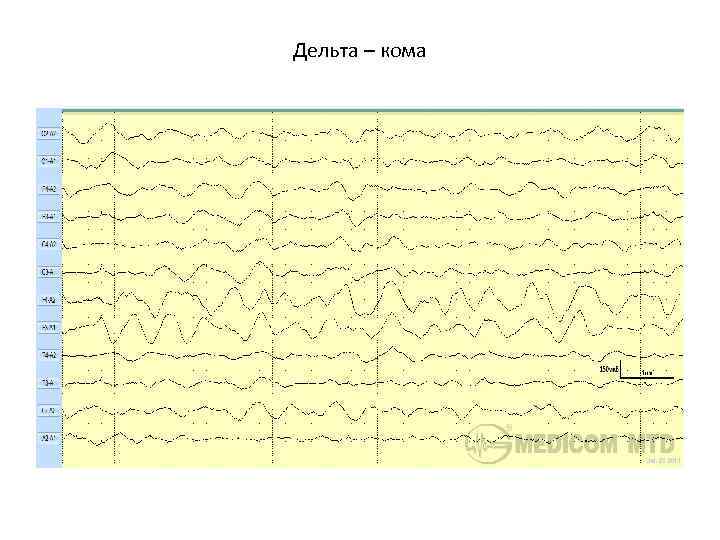 Дельта – кома 