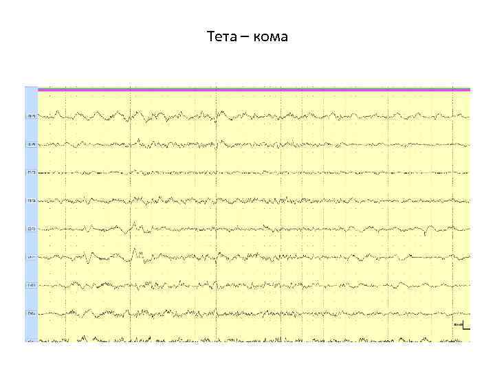 Тета – кома 