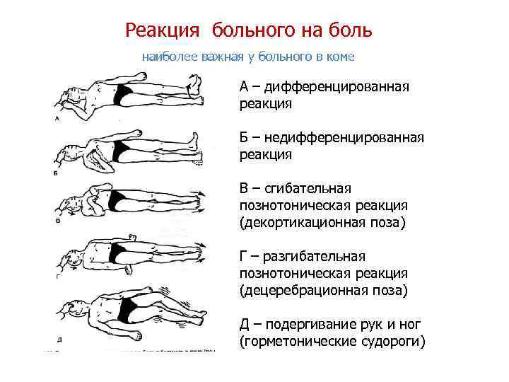 Реакция больного на боль наиболее важная у больного в коме А – дифференцированная реакция