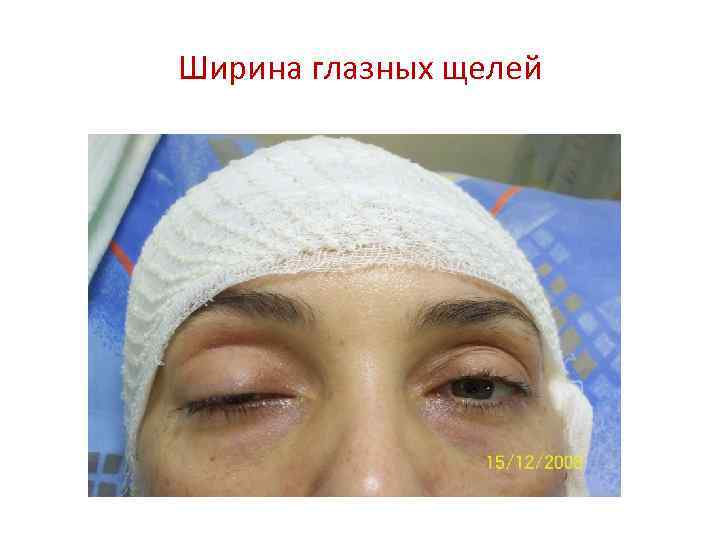 Ширина глазных щелей 