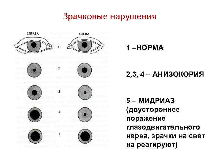Зрачковые нарушения 1 –НОРМА 2, 3, 4 – АНИЗОКОРИЯ 5 – МИДРИАЗ (двустороннее поражение