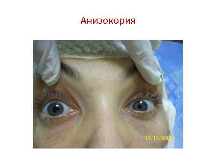 Анизокория 