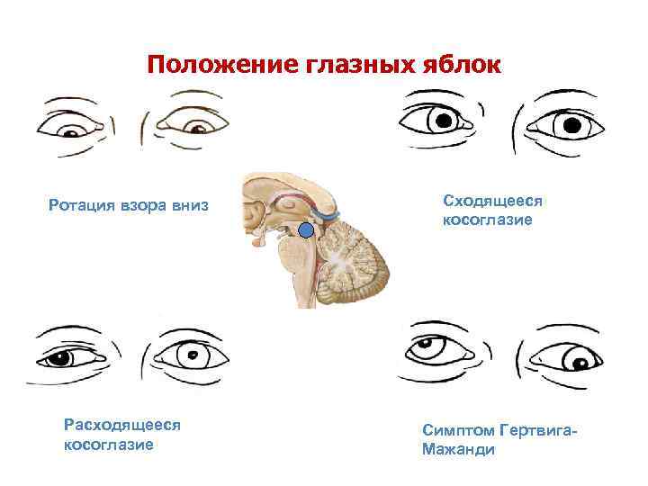 Положение глазных яблок Ротация взора вниз Расходящееся косоглазие Симптом Гертвига. Мажанди 