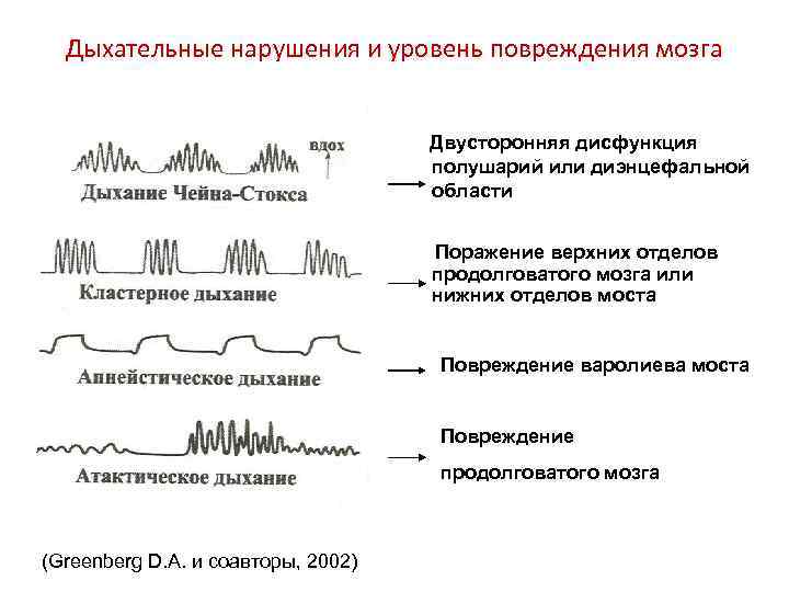 Дыхательные нарушения и уровень повреждения мозга Двусторонняя дисфункция полушарий или диэнцефальной области Поражение верхних