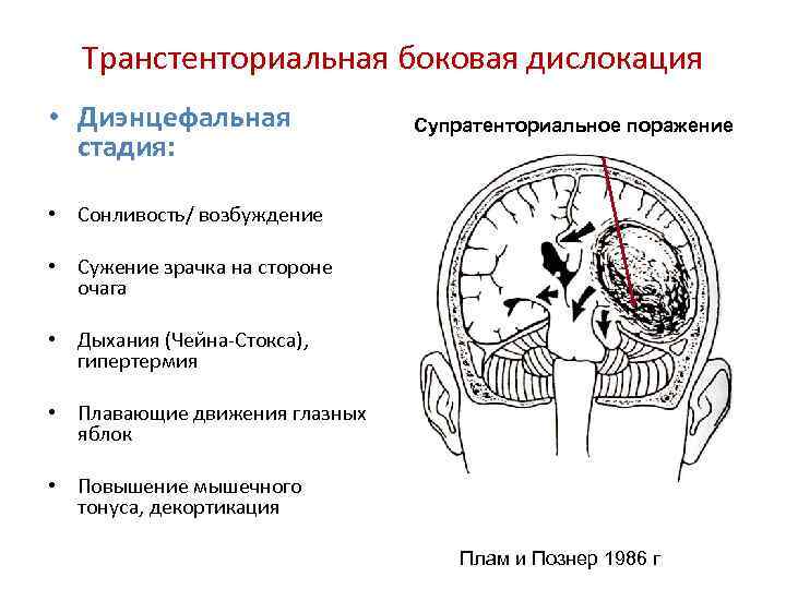 Транстенториальная боковая дислокация • Диэнцефальная стадия: Супратенториальное поражение • Сонливость/ возбуждение • Сужение зрачка