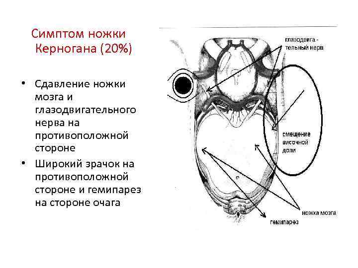 Симптом ножки Керногана (20%) • Сдавление ножки мозга и глазодвигательного нерва на противоположной стороне