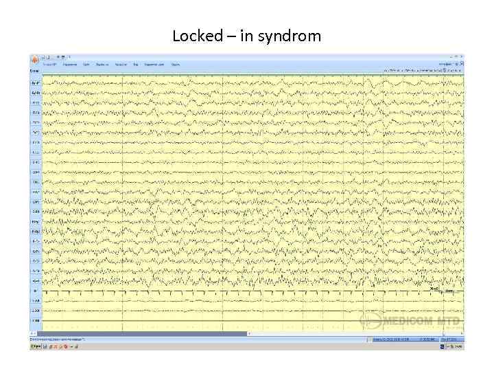 Locked – in syndrom 