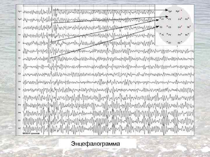 Энцефалограмма 