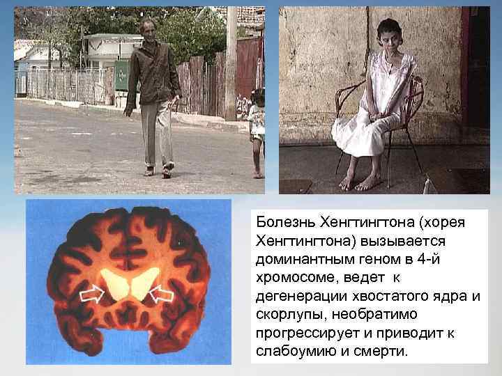 Болезнь Хенгтингтона (хорея Хенгтингтона) вызывается доминантным геном в 4 -й хромосоме, ведет к дегенерации
