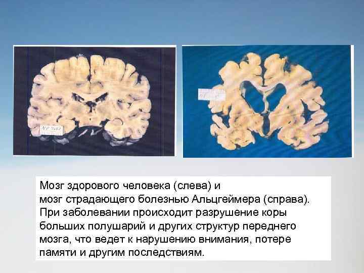 Мозг здорового человека (слева) и мозг страдающего болезнью Альцгеймера (справа). При заболевании происходит разрушение