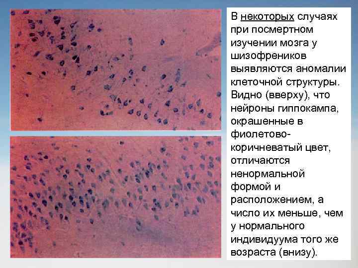 В некоторых случаях при посмертном изучении мозга у шизофреников выявляются аномалии клеточной структуры. Видно