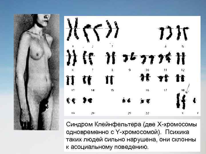 Синдром Клейнфельтера (две X-хромосомы одновременно с Y-хромосомой). Психика таких людей сильно нарушена, они склонны