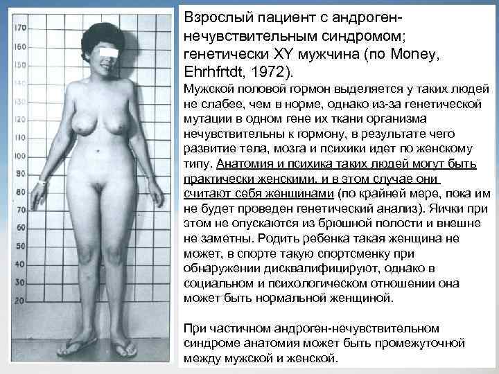 Взрослый пациент с андрогеннечувствительным синдромом; генетически XY мужчина (по Money, Ehrhfrtdt, 1972). Мужской половой