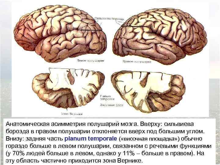 Анатомическая асимметрия полушарий мозга. Вверху: сильвиева борозда в правом полушарии отклоняется вверх под большим