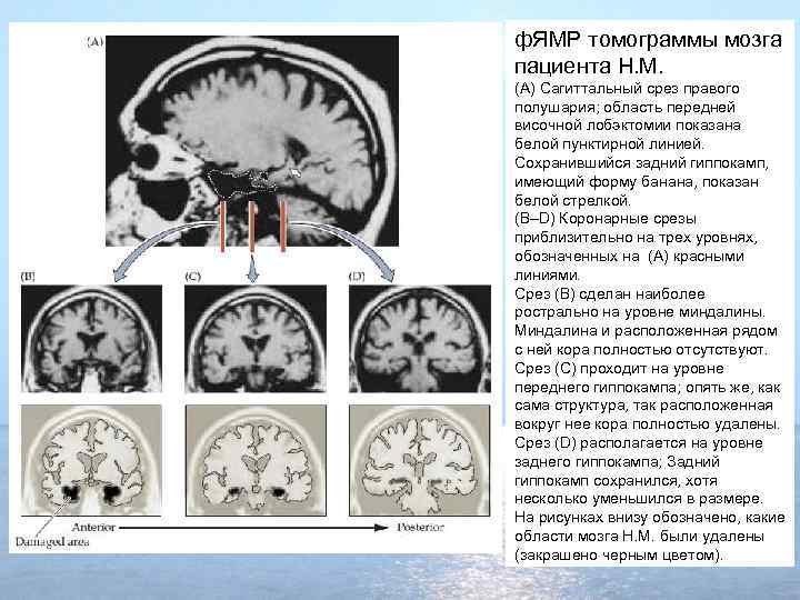 ф. ЯМР томограммы мозга пациента H. M. (A) Сагиттальный срез правого полушария; область передней