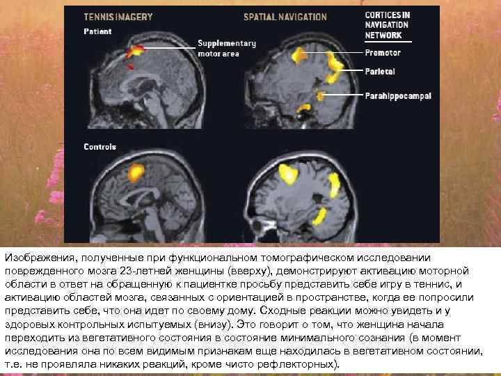 Изображения, полученные при функциональном томографическом исследовании поврежденного мозга 23 -летней женщины (вверху), демонстрируют активацию