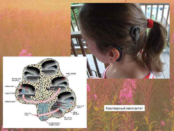 Кохлеарный имплантат 