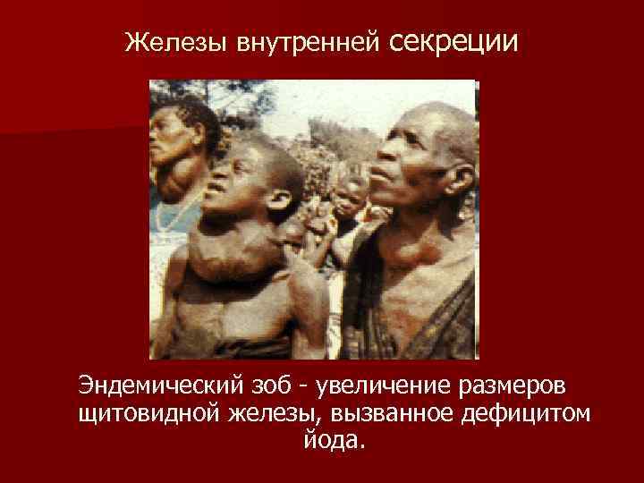 Железы внутренней секреции Эндемический зоб - увеличение размеров щитовидной железы, вызванное дефицитом йода. 