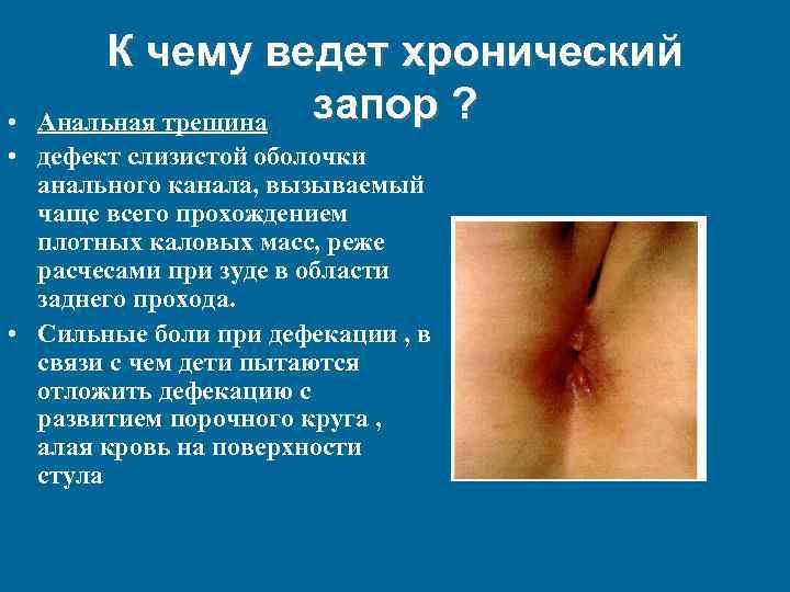 К чему ведет хронический запор ? Анальная трещина • • дефект слизистой оболочки анального