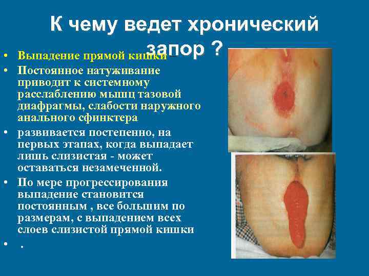 К чему ведет хронический запор ? Выпадение прямой кишки – • • Постоянное натуживание