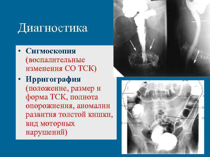 Хронические запоры презентация