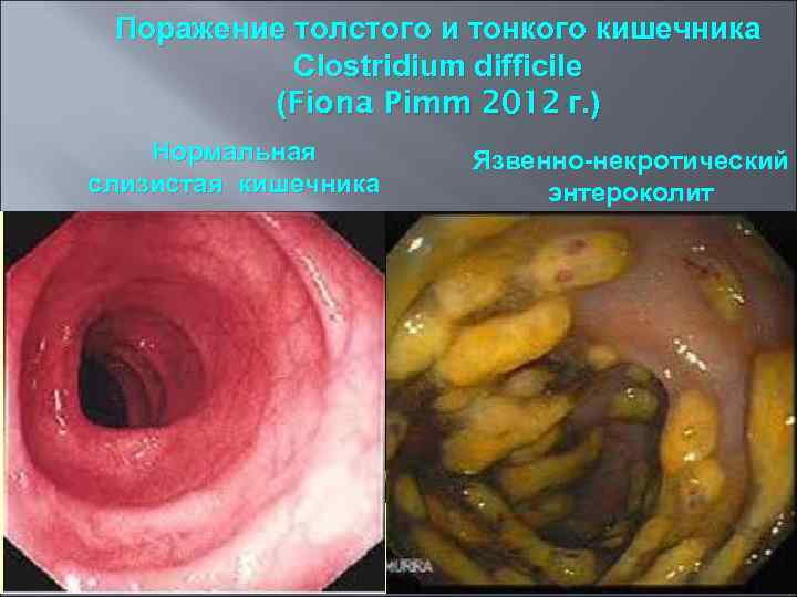 Поражение толстого и тонкого кишечника Clostridium difficile (Fiona Pimm 2012 г. ) Нормальная слизистая